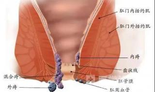 痔疮的最佳治疗方法